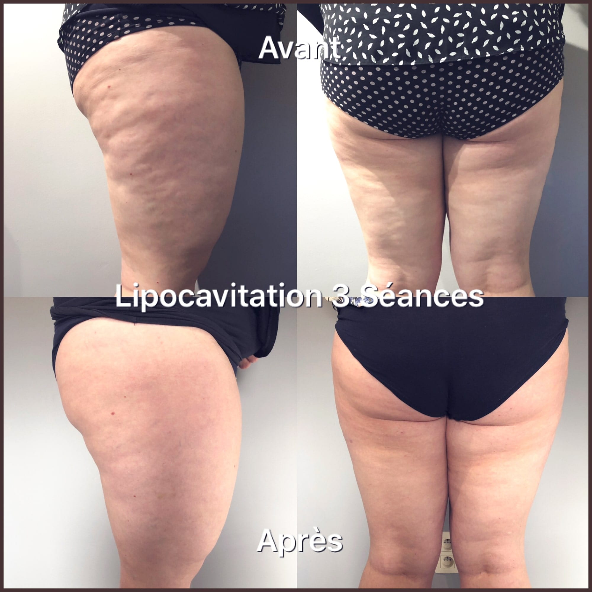 Lipocavitation